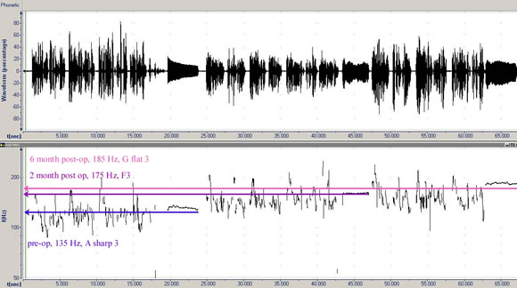 Voice Feminization Laser Trans Gender Voice Surgery Minimally Invasive Voice Reassignment