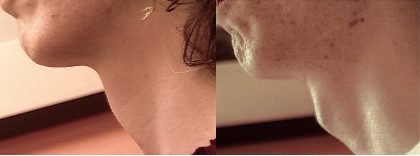 Adam's Apple Augmentation