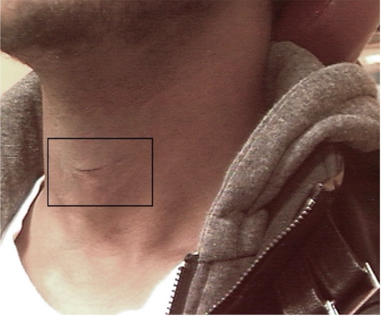 Incision