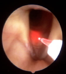 HPV - Papillomas of the Larynx