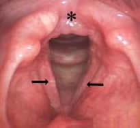 acute laryngitis