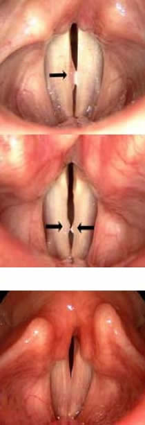 Hoarseness Voice Changes Haben Practice For Voice And Laryngeal Laser Surgery Pllc Rochester Ny