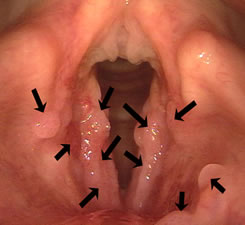papillomavirus larynx symptomes)