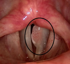hpv in larynx)