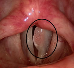 papilloma voice symptoms virusul giardiei