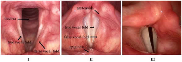 Correction of Vocal Cord Paralysis Medialization Laryngoplasty